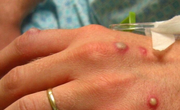 medicamentos contra varíola