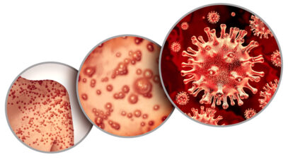 Brasil monitora suspeitas de varíola dos macacos