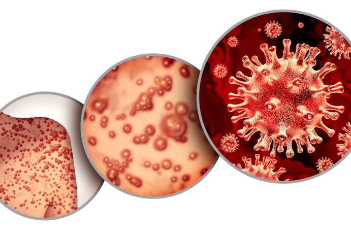 Varíola dos macacos no Brasil