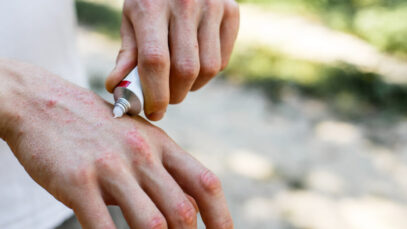 Acetato de hidrocortisona