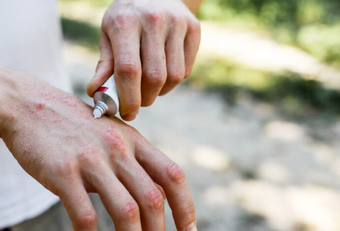 Acetato de hidrocortisona