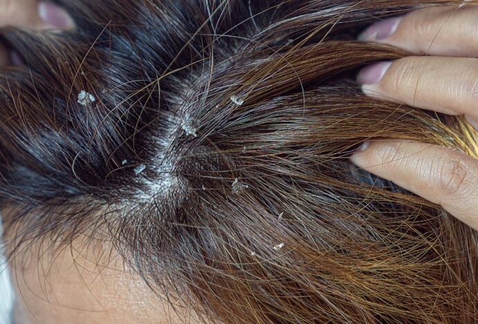 dermatite seborreica