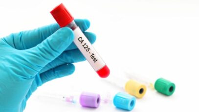 A importância da dosagem da proteína CA 125 no sangue CA 125