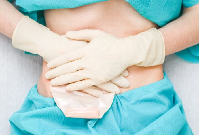 colostomia