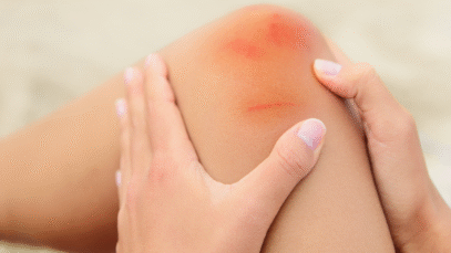 Deu uma trombada e está com um roxo? Você tem uma equimose