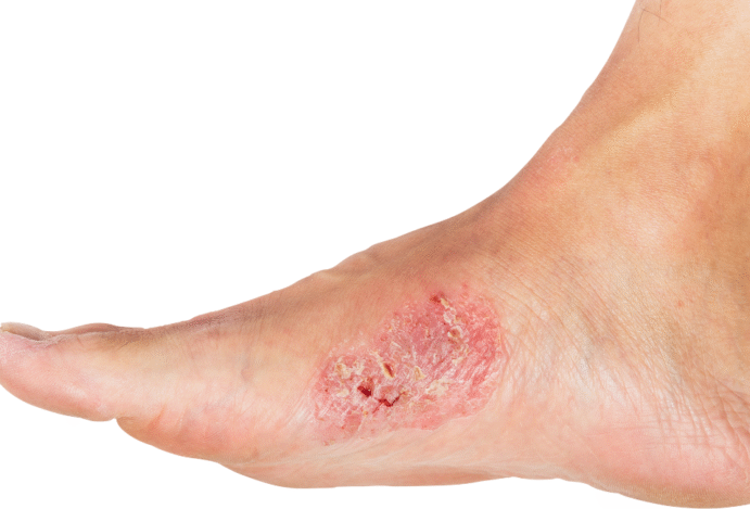 Imagem relacionada a: Escaras: o que são e tratamento