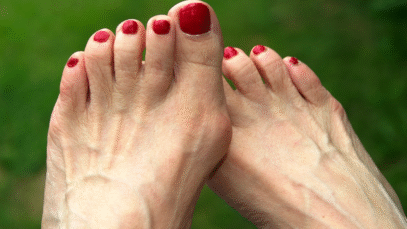 Cirurgia é a solução para o joanete?