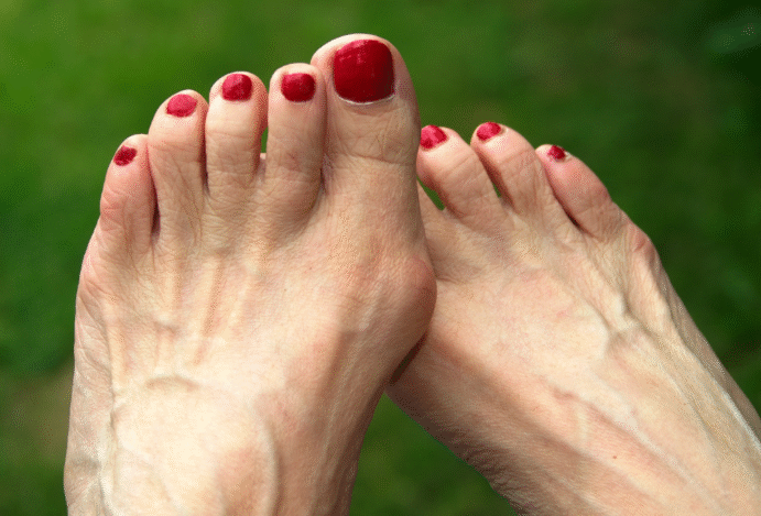 Imagem relacionada a: Cirurgia é a solução para o joanete?