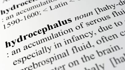 hidrocefalia