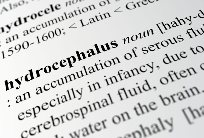 hidrocefalia
