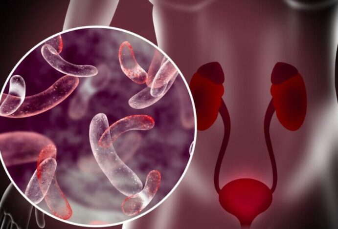 infecção urinária