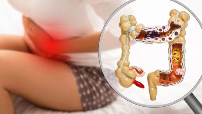 inflamação no intestino