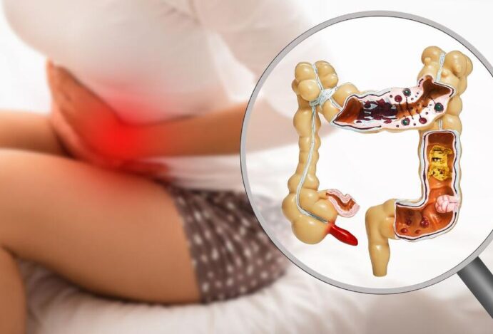 inflamação no intestino