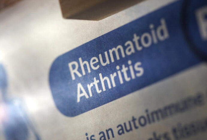 artrite reumatoide
