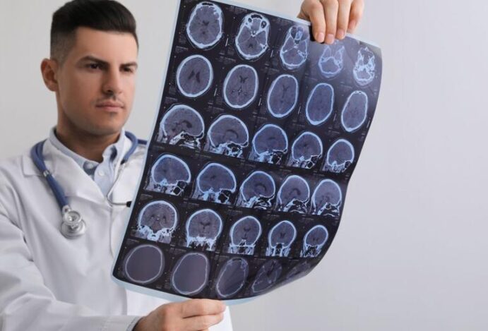 Imagem relacionada a: Quais os sintomas iniciais da esclerose múltipla?