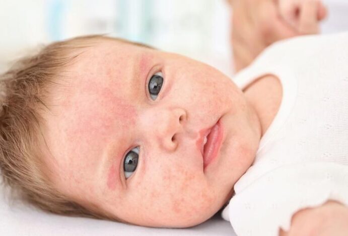 Alergia em bebês