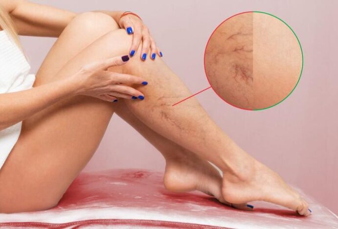má circulação nas pernas