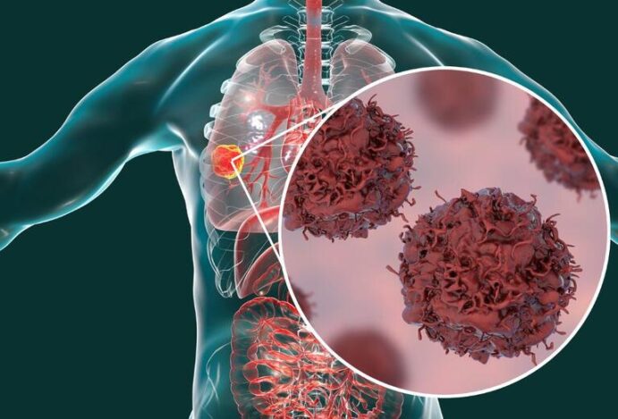 Câncer de pulmão