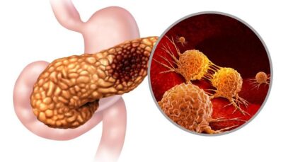 Câncer de pâncreas