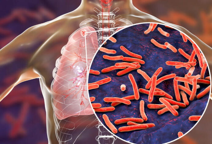 Tratamento da tuberculose