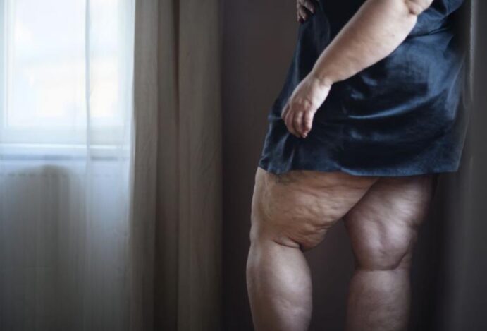Lipedema