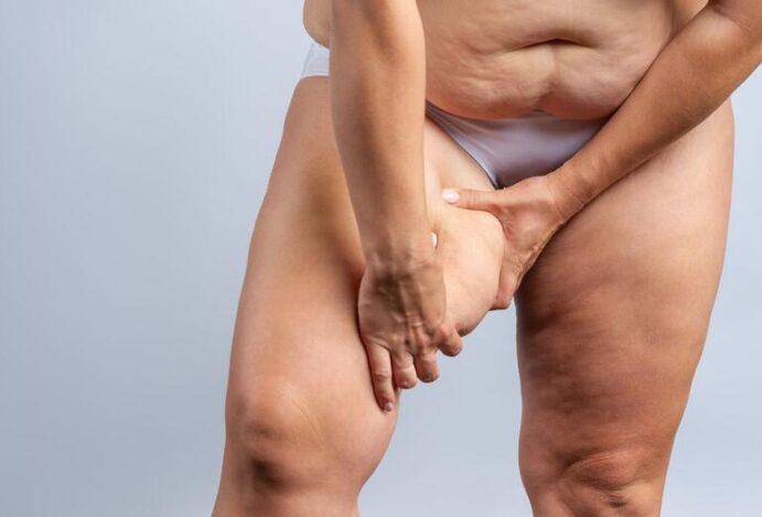 lipedema