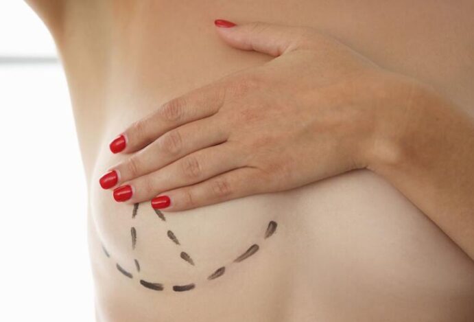 Reconstrução mamária