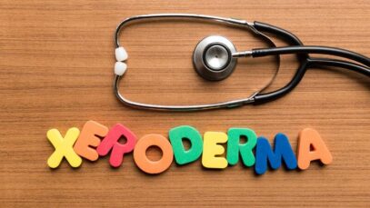 xeroderma pigmentoso