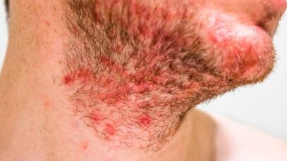 dermatite seborreica