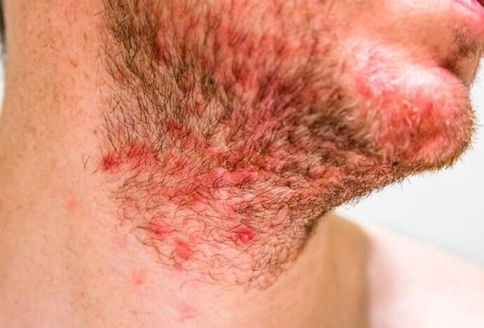 dermatite seborreica