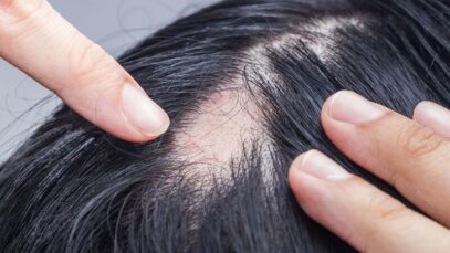 Alopecia areata