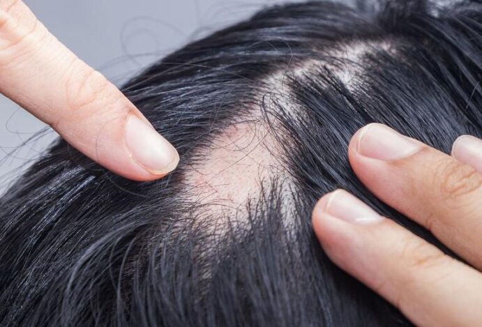 Alopecia areata
