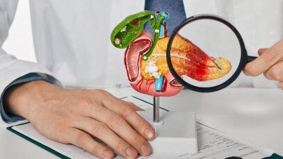 Câncer de pâncreas