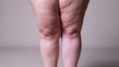Lipedema