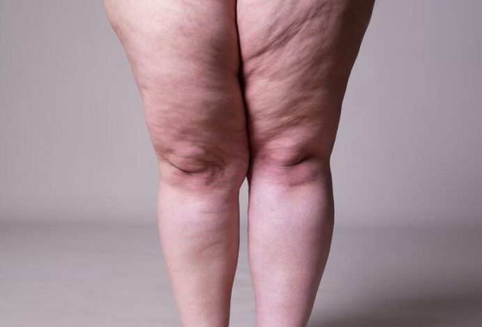 Lipedema