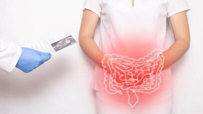 Câncer de intestino