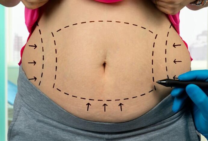 mitos e verdades sobre a lipoaspiração