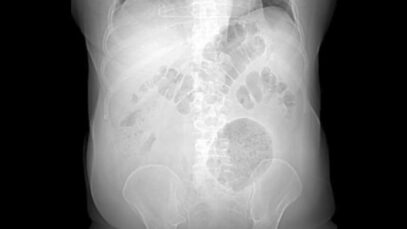 divertículo gigante