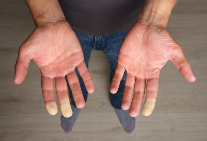 fenômeno de raynaud