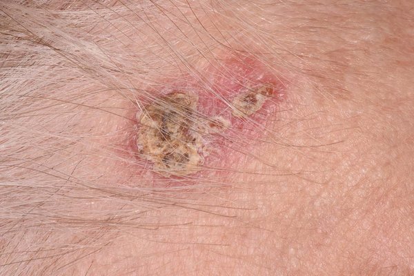 C0585497-Basal_cell_carcinoma_on_a_woman_s_f.max-600×600