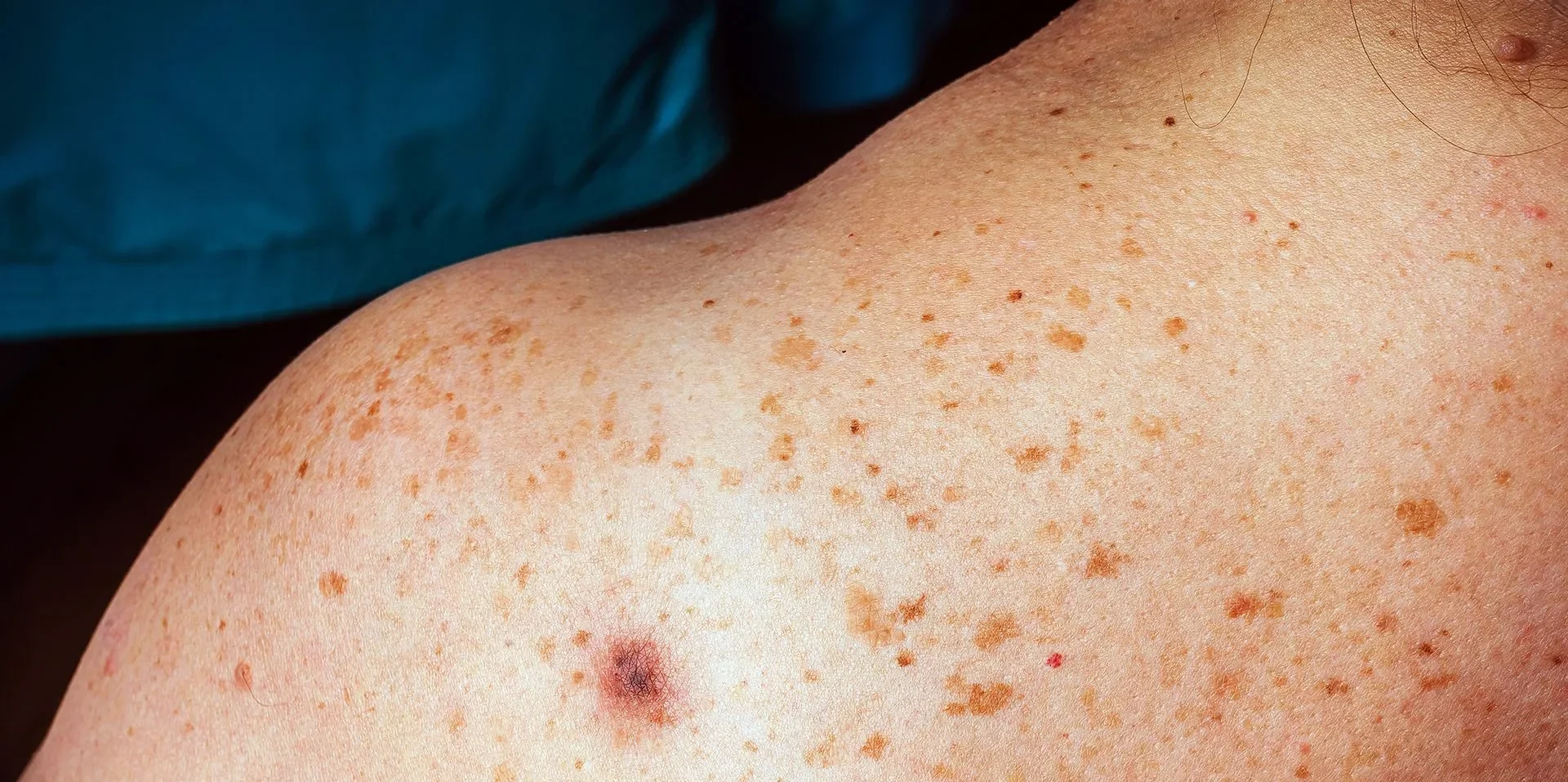 Moleskincancer-2880w-e1749516921163