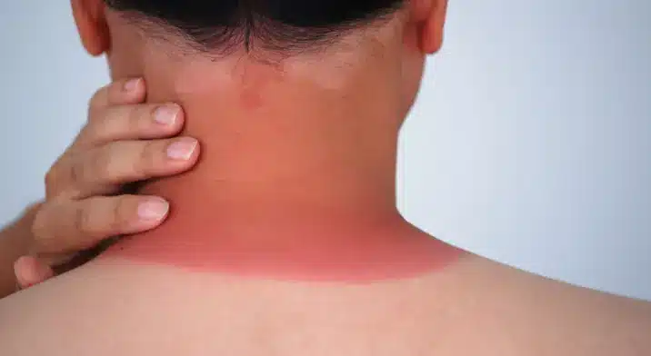 Skin-Cancer-1