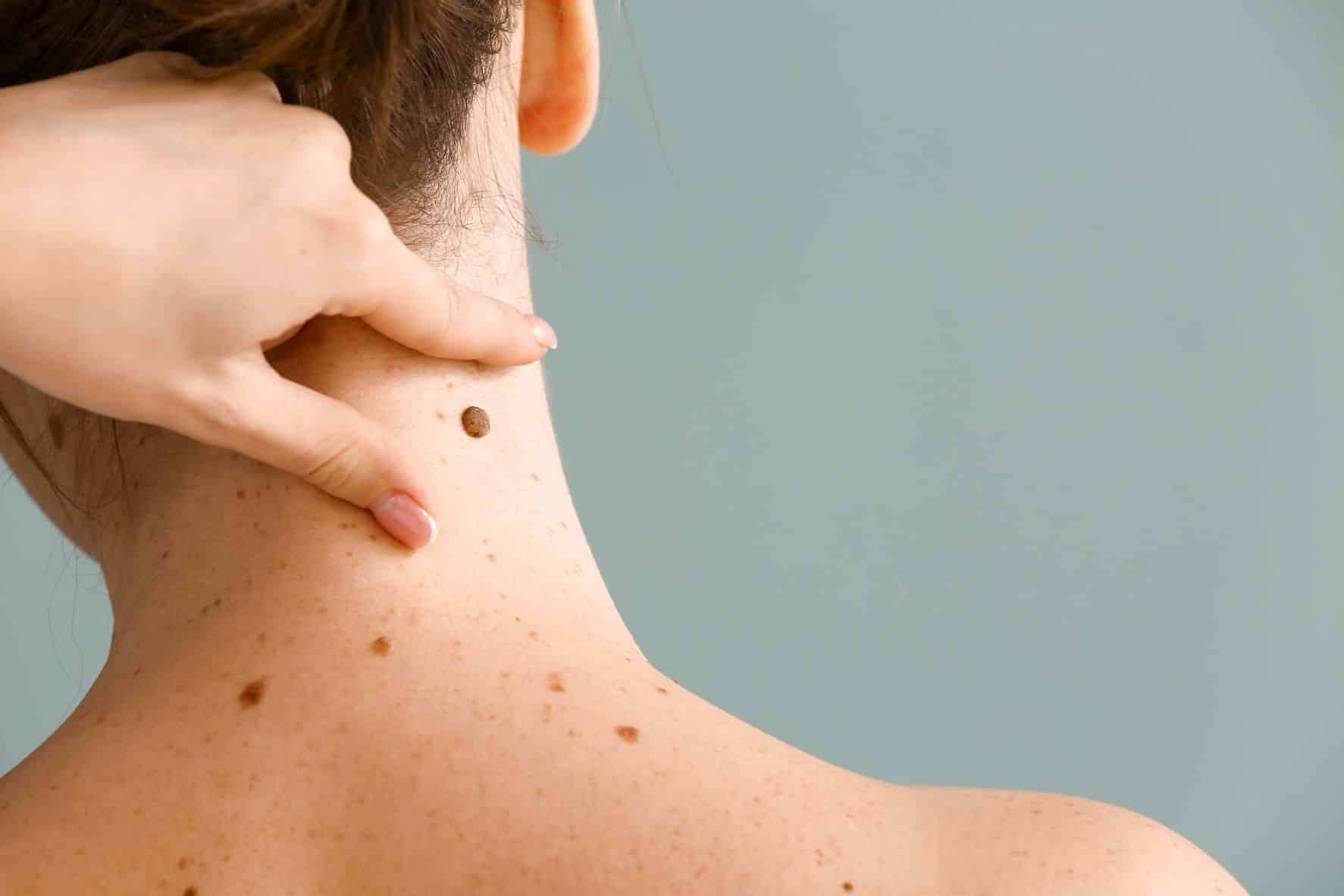 Woman-neck-mole-skin-cancer